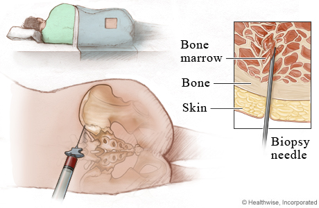 Bone marrow biopsy